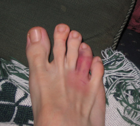 [Image: broken%20toe.JPG]